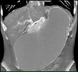 Gastric Outlet Obstruction By An Antral Tumor - CTisus CT Scan