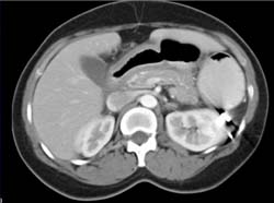 Linitis Plastica - CTisus CT Scan