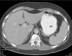 Oral Omnipaque Used as A Positive Contrast Agent - CTisus CT Scan