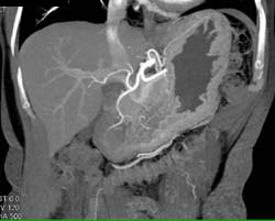 Gastric Varices-mild - CTisus CT Scan