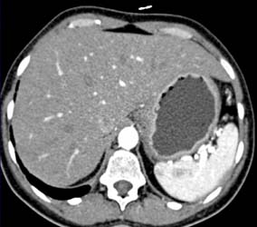 Linitis Plastica-primary Gastric Adenocarcinoma - CTisus CT Scan