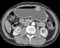 GIST Tumor - CTisus CT Scan