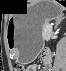 GIST Tumor - CTisus CT Scan