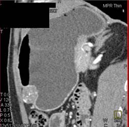 GIST Tumor - CTisus CT Scan