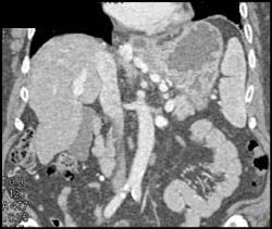 Gastric Varices - CTisus CT Scan