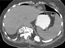 Normal Positive Contrast in Stomach-oral Omnipaque Solution - CTisus CT Scan