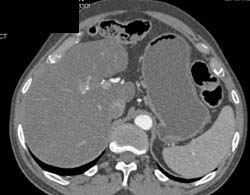 Gastric Pseudotumor-looks Like An Adrenal Mass - CTisus CT Scan