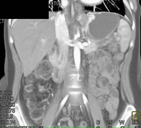 Adenocarcinoma of the Gastric Fundus - CTisus CT Scan