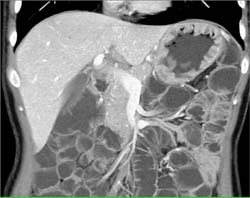 Gastric Adenocarcinoma - CTisus CT Scan