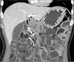 Gastric Adenocarcinoma - CTisus CT Scan