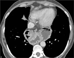 Paraesophageal Hiatal Hernia - CTisus CT Scan