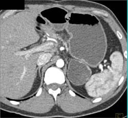 Gastric Pseudotumor Simulates Adrenal Cystadenoma But Adrenal Clearly Seen-see Other Phase - CTisus CT Scan