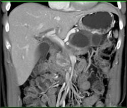 Pseudocyst Compresses Splenic Vein and Patient Has Gastric Varices - CTisus CT Scan