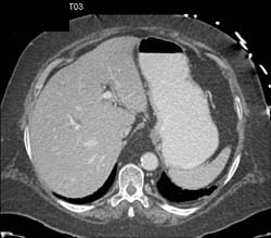 Oral Omnipaque in Stomach - CTisus CT Scan