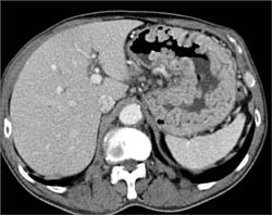 Renal Cancer With Hypertrophied Gastric Folds- Zollinger-Ellison - CTisus CT Scan