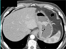 Gastric Adenocarcinoma - CTisus CT Scan