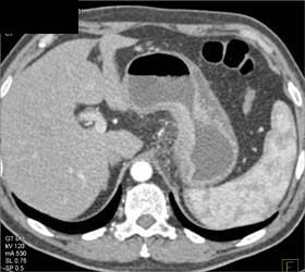 Gastric Adenocarcinoma - CTisus CT Scan