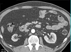 Incidental Lipoma in Duodenum in Patient With Gastric Cancer Near Eg Junction - CTisus CT Scan