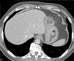 Gastric Adenocarcinoma - CTisus CT Scan