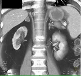 Gastric Cancer - CTisus CT Scan