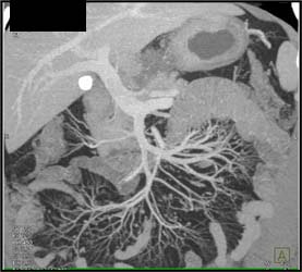 Gastric Adenocarcinoma and Small Mesenteric Nodes - CTisus CT Scan