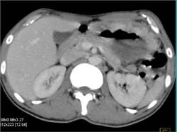 Gastric Lymphoma - CTisus CT Scan