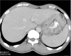 Gastric Lymphoma - CTisus CT Scan