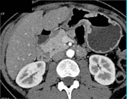 Linitis Plastica - CTisus CT Scan