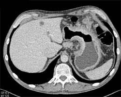 Gastric Carcinoma With Implants on Omentum - CTisus CT Scan