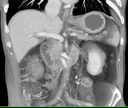 Gastric Cancer - CTisus CT Scan