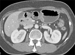 Antral Collapse With Pseudomass - CTisus CT Scan