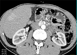 Post Partial Gastrectomy - CTisus CT Scan