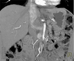 Metastatic Islet Cell to Liver - CTisus CT Scan