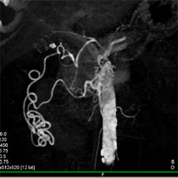 Prominent Collaterals From Hepatic Artery to SMA - CTisus CT Scan