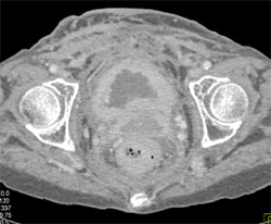 Drop Metastases From Gastric Cancer - CTisus CT Scan