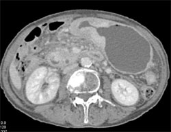 Gastric Cancer - CTisus CT Scan