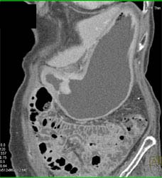 Gastric Cancer - CTisus CT Scan