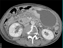 Gastric Cancer - CTisus CT Scan