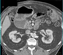 Tumor in Duodenum - CTisus CT Scan