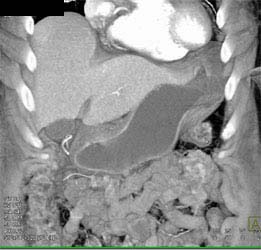 Antral Infiltration - CTisus CT Scan