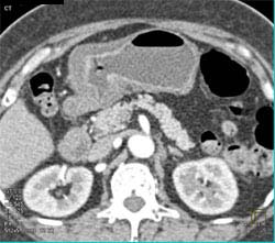 Gastric Cancer With Ulcer - CTisus CT Scan