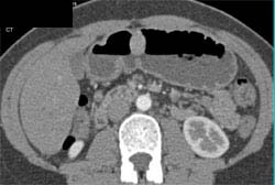 Gastric Leiomyoma - CTisus CT Scan