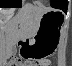 Gastric Leiomyoma - CTisus CT Scan