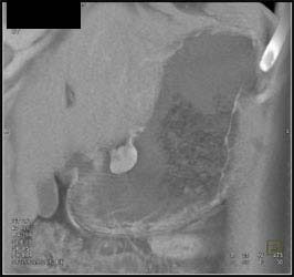 Gastric Leiomyoma - CTisus CT Scan