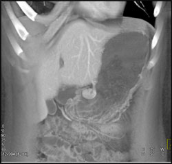 Gastric Leiomyoma - CTisus CT Scan