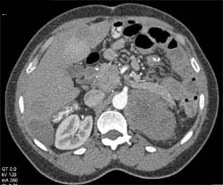 Recurrent GIST Tumor - CTisus CT Scan