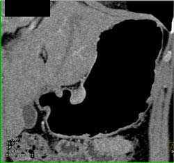 Gastric Leiomyoma - CTisus CT Scan