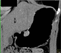 Gastric Leiomyoma - CTisus CT Scan