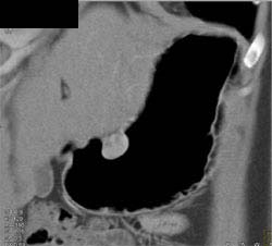 Gastric Leiomyoma - CTisus CT Scan