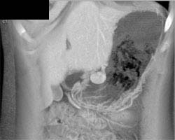 Gastric Leiomyoma - CTisus CT Scan